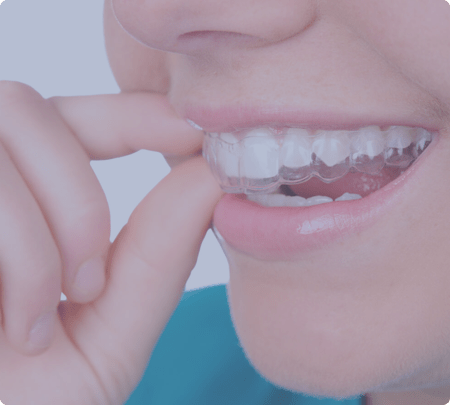 Invisalign | Main Street Dental Airdrie