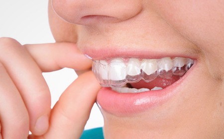 Invisalign | Main Street Dental Airdrie